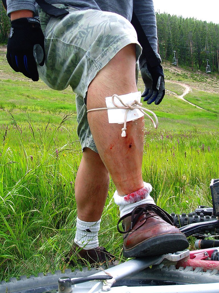 Recognizing and Responding to Common Wilderness Injuries